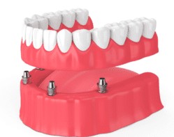 https://dentalaesthetics.com/wp-content/uploads/2023/01/Dental-implant-secured-Denture-DENTAL-AESTHETICSg.jpg