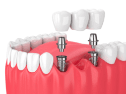 https://dentalaesthetics.com/wp-content/uploads/2023/01/Implant-supported-dental-bridge-DENTAL-AESTHETICS.png