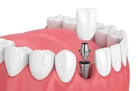 https://dentalaesthetics.com/wp-content/uploads/2023/01/dental-implant-SINGLE-TOOTH-DENTAL-AESTHETICS.jpg
